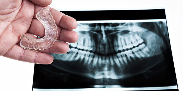 immagine relativa alle disfunzioni articolari, raffigurante un bite con una radiografia sullo sfondo