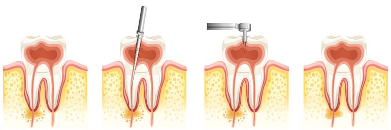 illustrazione che raffigura il trattamento ondodontico della devitalizzazione