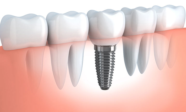 illustrazione di implantologia dentale