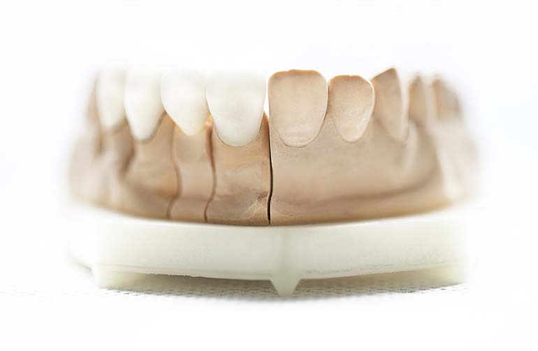 immagine di protesi dentarie